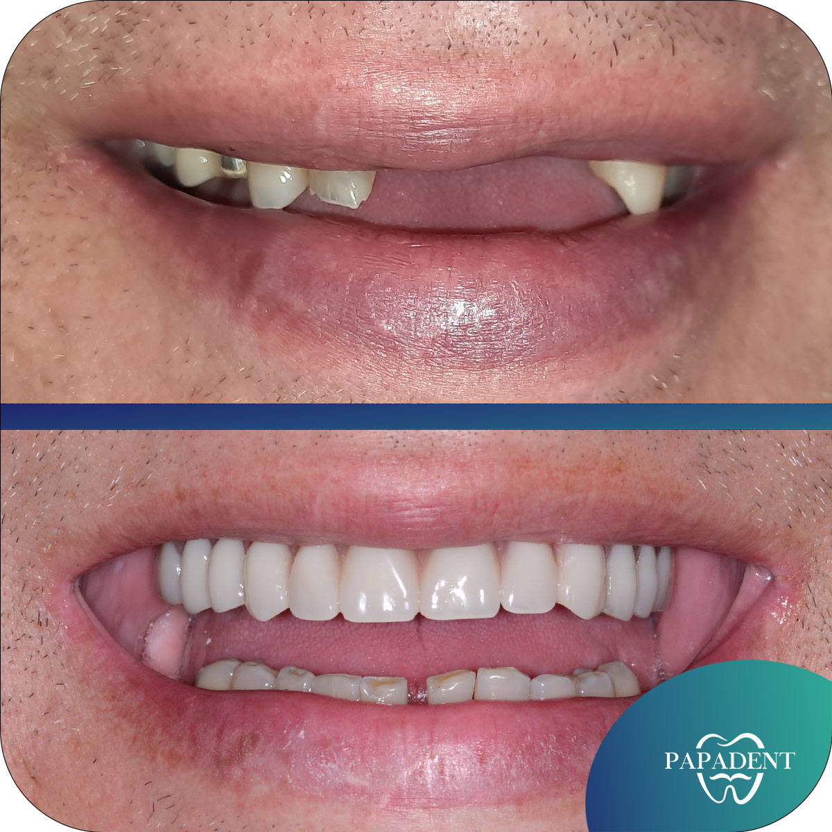 Dantų protezai all-on-4 prie&scaron; ir po