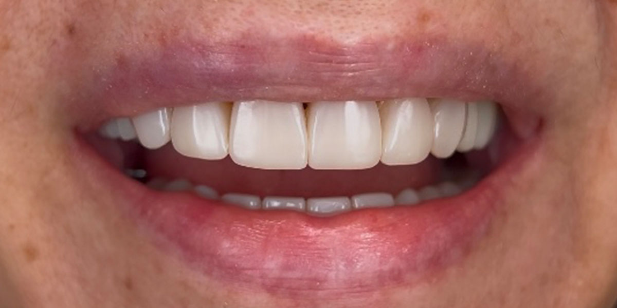 atkurta šypsena po estetinio plombavimo