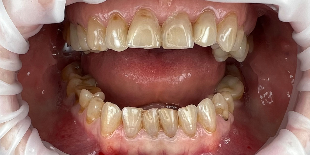 dantys prieš estetinį plombavimą