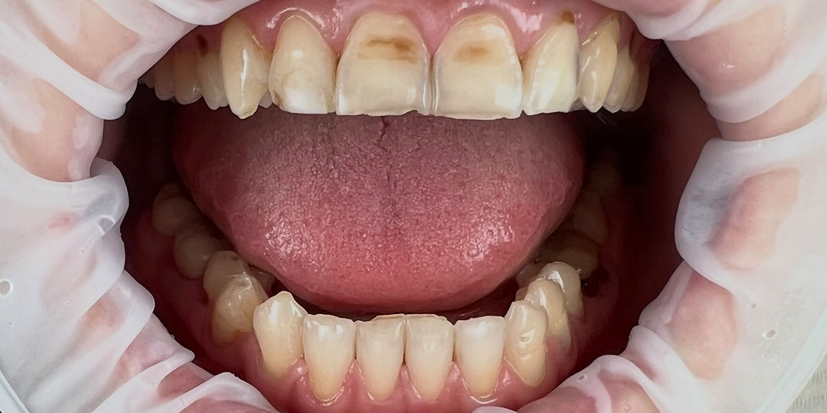 dėmėti dantys prieš estetinį plombavimą