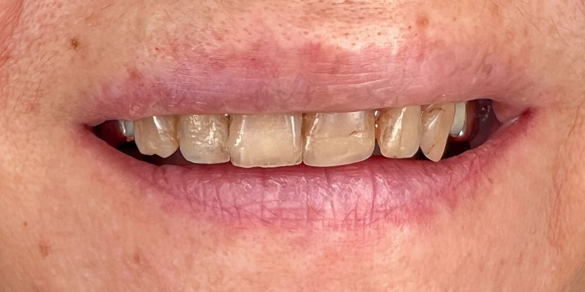 nudilę dantys prieš estetinį plombavimą