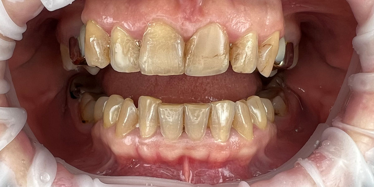 nudilę dantys prieš estetinį plombavimą