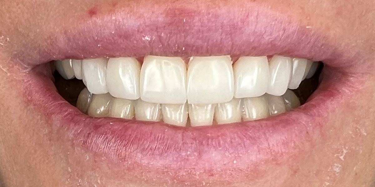 priekiniai dantys po estetinio plombavimo