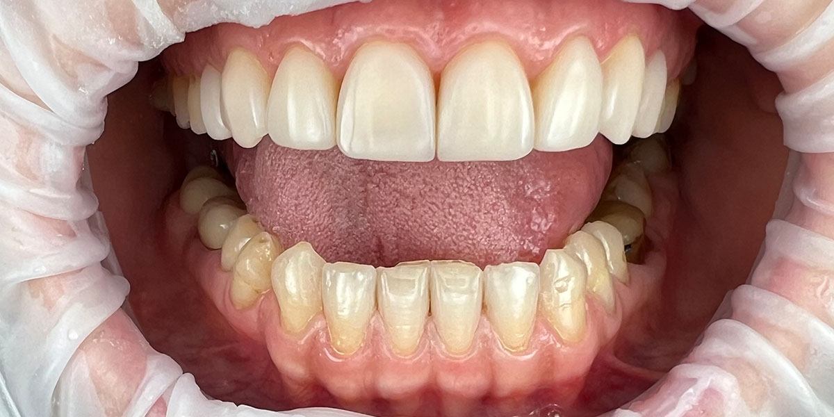 šypsena po estetinio plombavimo