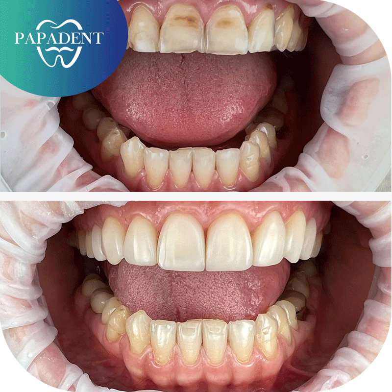 viršutinių dantų estetinis plombavimas