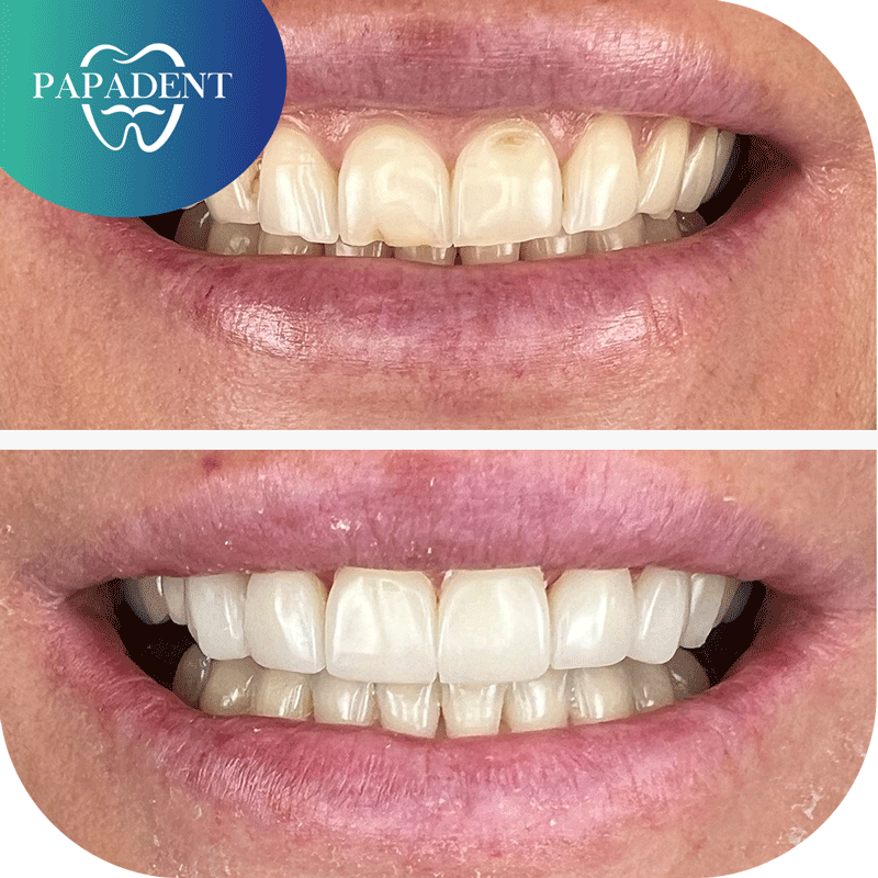 viršutinių priekinių dantų estetinis plombavimas