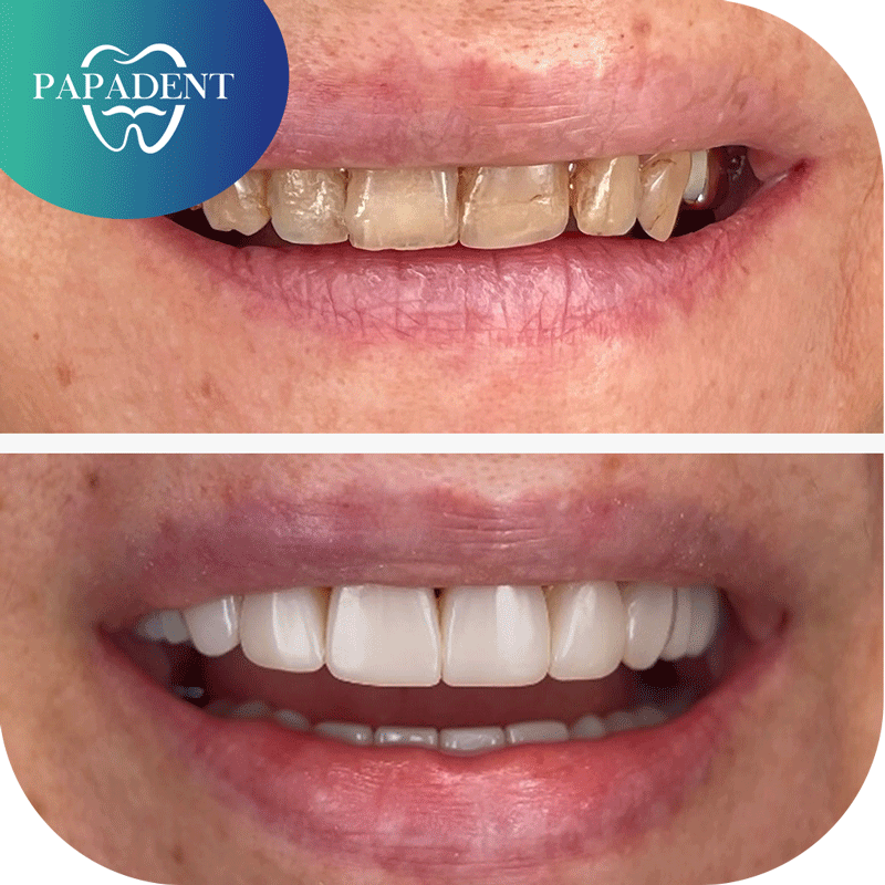 viršutinių priekinių dantų estetinis plombavimas