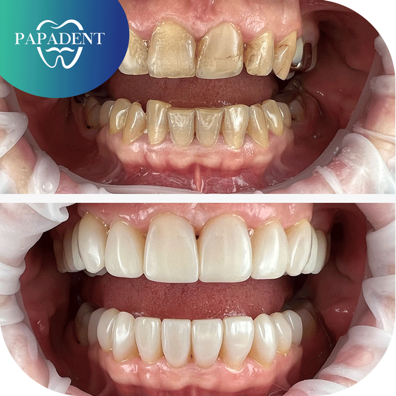 visų dantų estetinis plombavimas