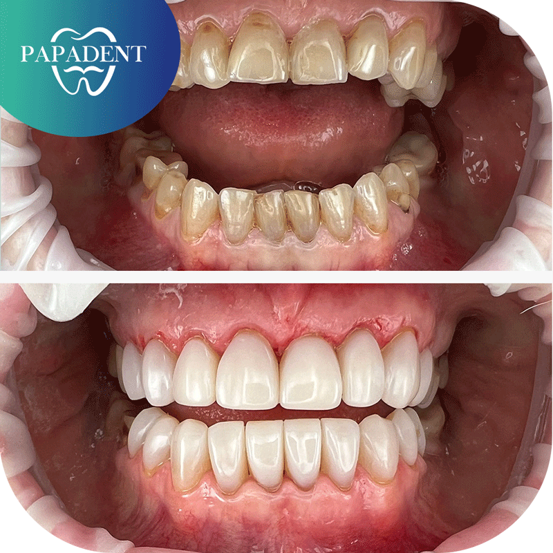 Visų dantų estetinis plombavimas