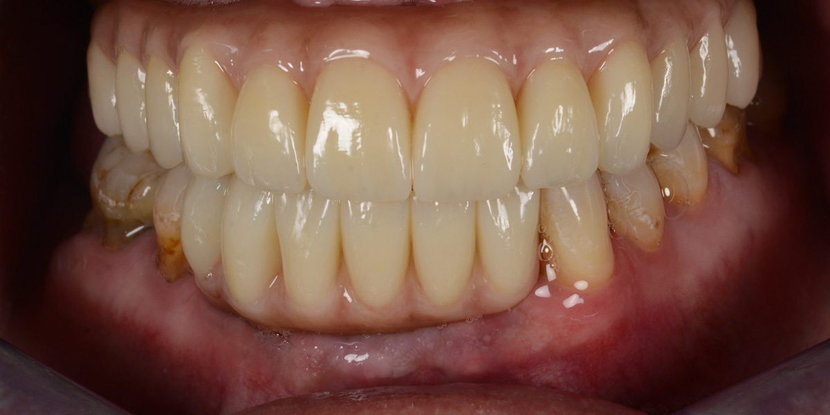 abiejų žandikaulių implantacija pagal ALL-ON-4® metodiką - po