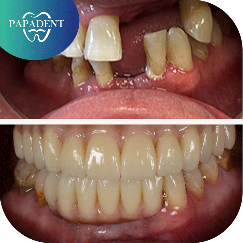 abiejų žandikaulių implantacija pagal ALL-ON-4® metodiką