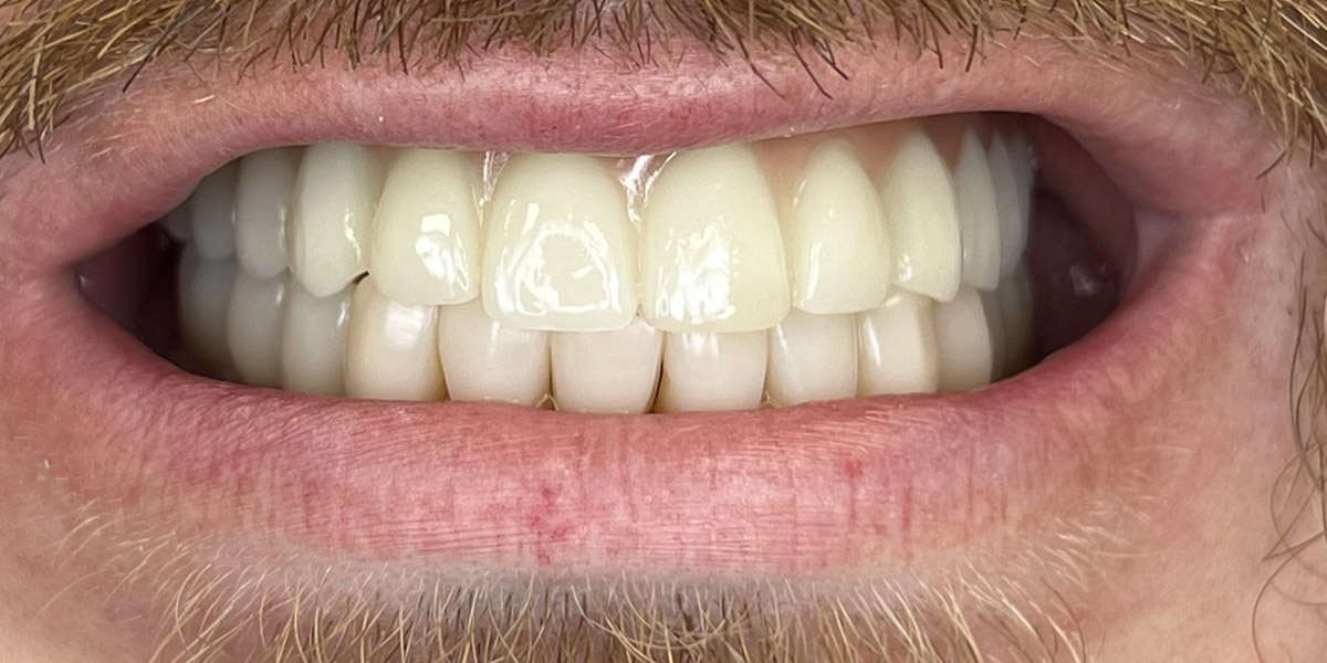 viso žandikaulio protezavimas pritaikant All on 4® metodiką - po