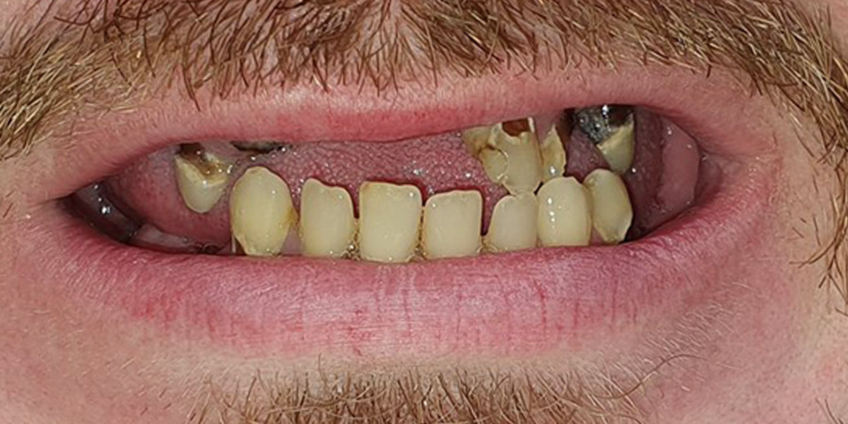 viso žandikaulio protezavimas pritaikant All-on-4® metodiką - prieš