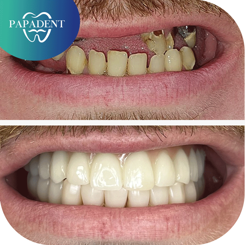 Viso žandikaulio protezavimas pritaikant All-on-4® metodiką